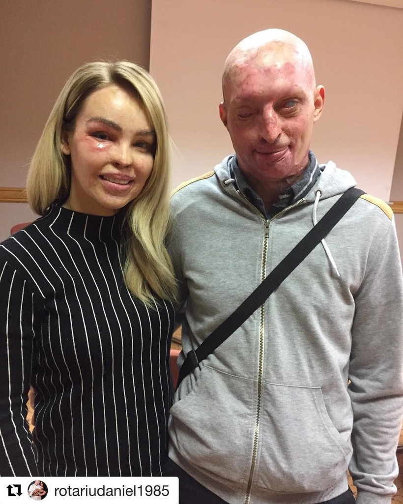 Facebook'tan tanıştığı adam tecavüz edip asitle yaktı ama o... - Resim: 2