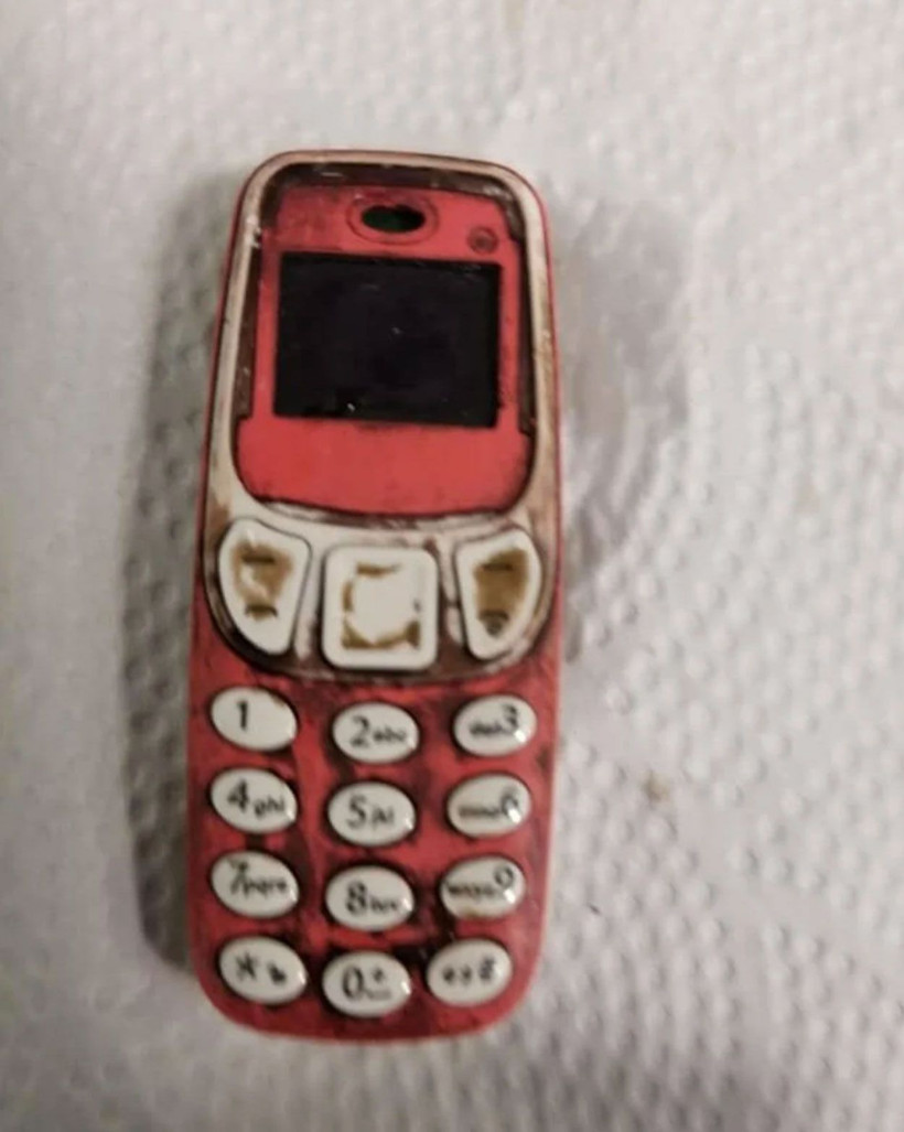 Midesinden Nokia 3310 telefon çıktı! Doktorları şaşırtan ameliyat - Resim: 1