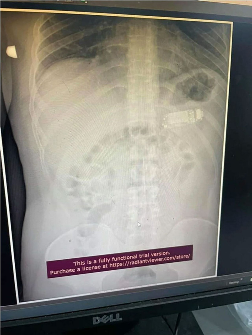 Midesinden Nokia 3310 telefon çıktı! Doktorları şaşırtan ameliyat - Resim: 2