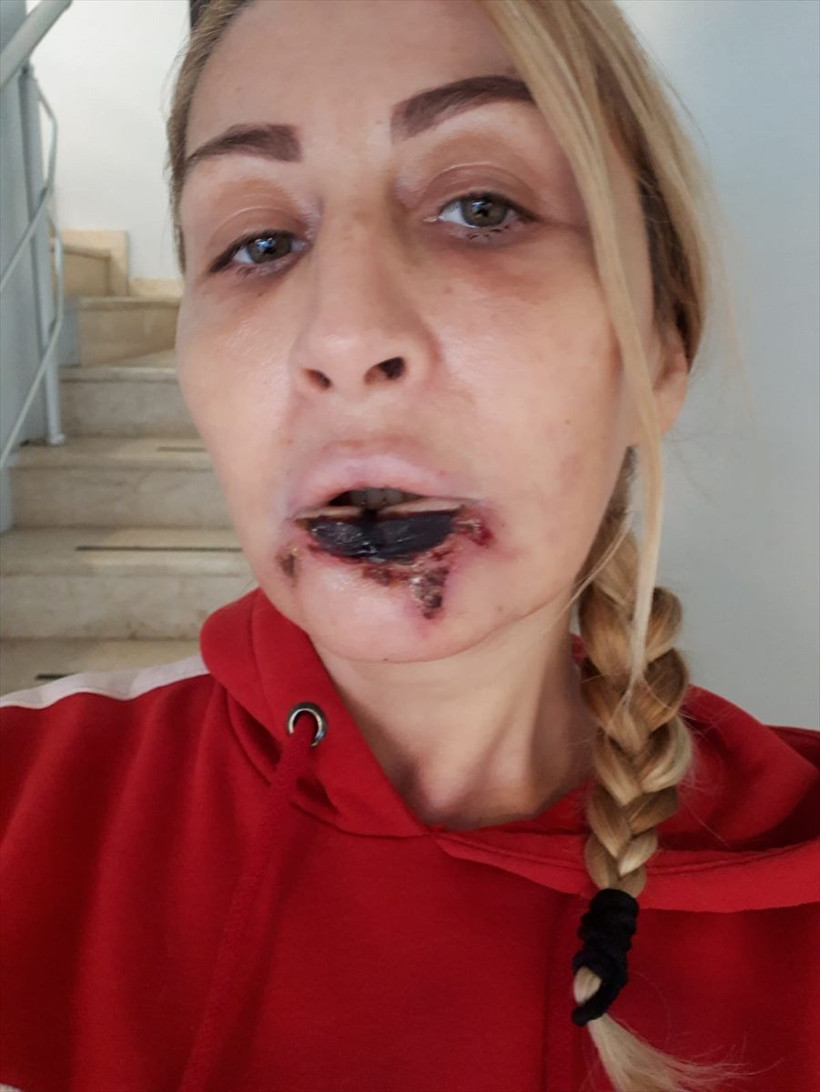 Antalya'da estetik faciası kadının dudağı çürüyerek düştü! - Resim: 3