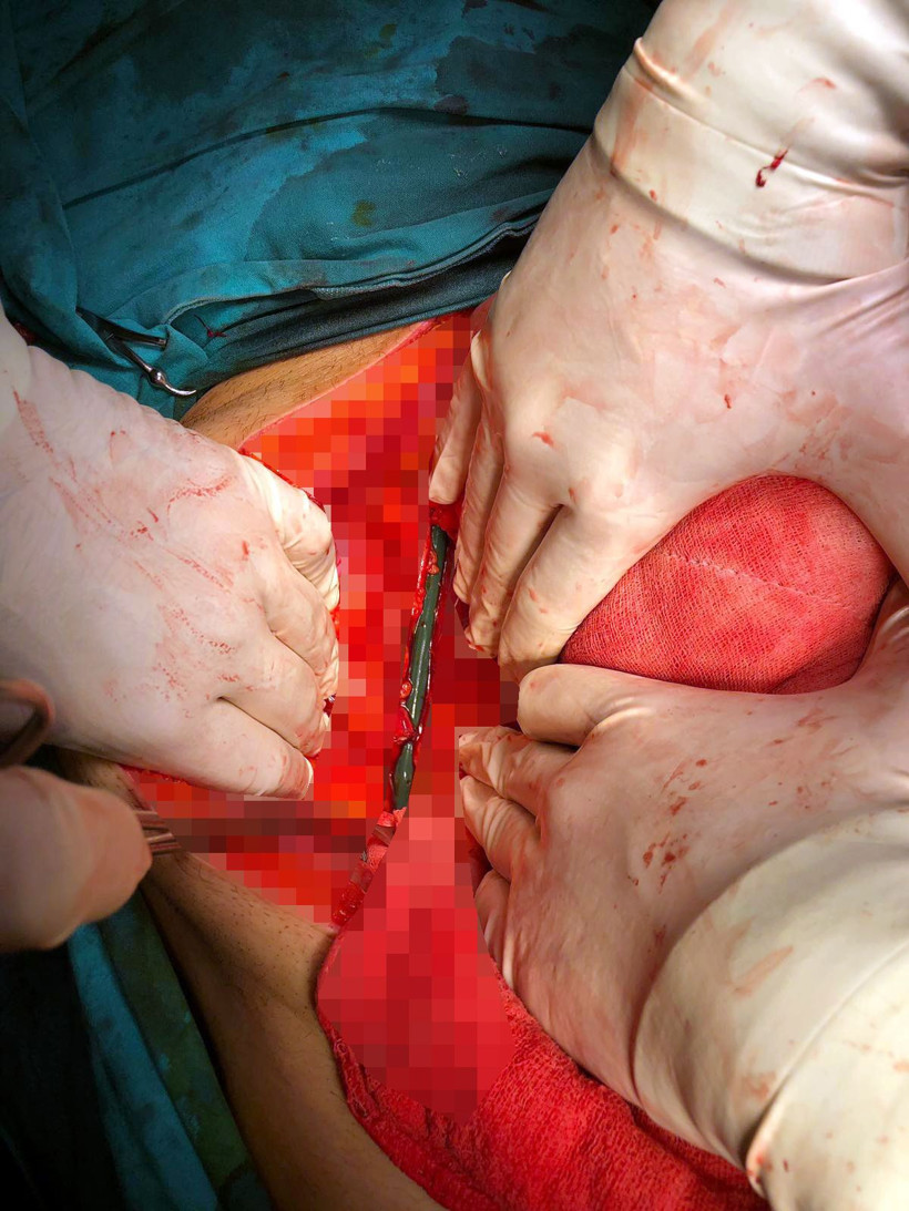 Antalya'da 80 santimlik demir bacağından girdi ciğerine saplandı - Resim: 3