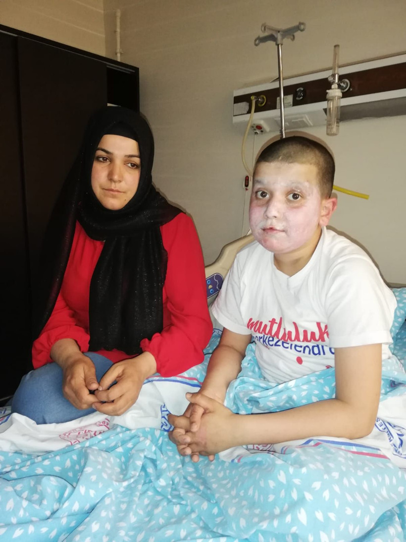 Sprey boya kutusu yüzünde patlamıştı işte 11 yaşındaki çocuğun son hali - Resim: 3