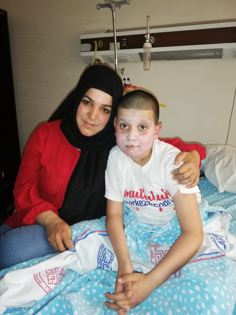 Sprey boya kutusu yüzünde patlamıştı işte 11 yaşındaki çocuğun son hali - Resim: 2