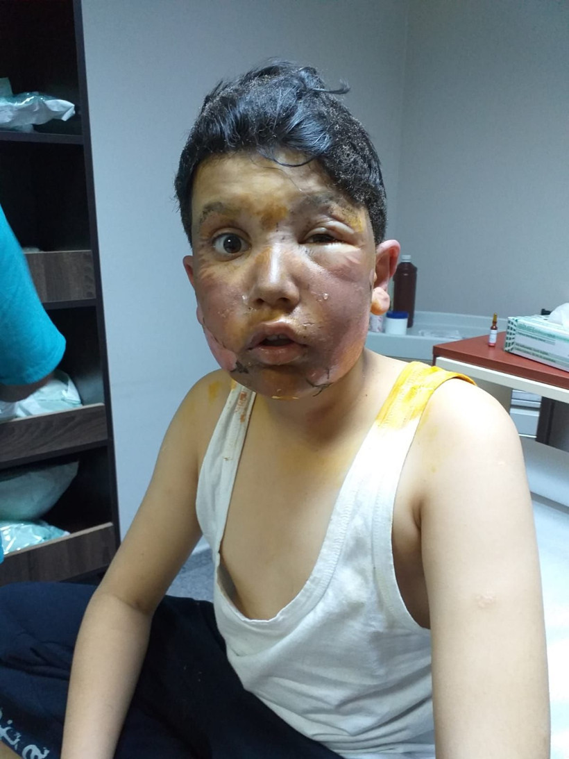 Sprey boya kutusu yüzünde patlamıştı işte 11 yaşındaki çocuğun son hali - Resim: 4