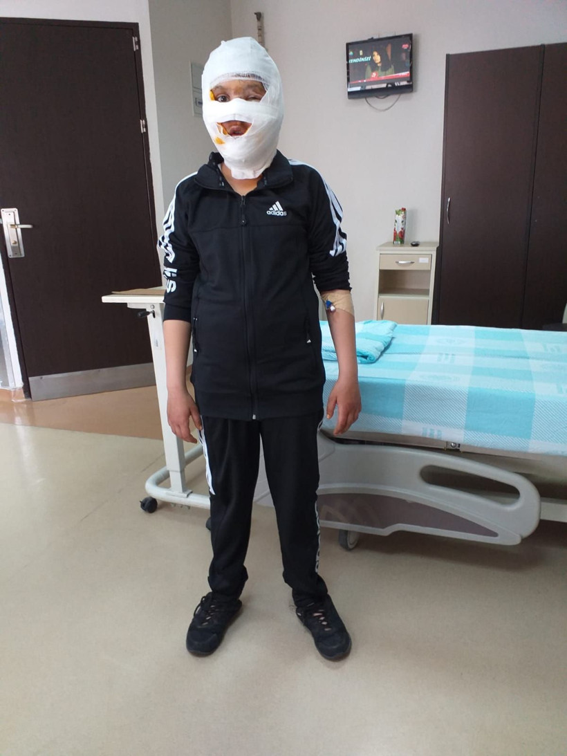 Sprey boya kutusu yüzünde patlamıştı işte 11 yaşındaki çocuğun son hali - Resim: 1