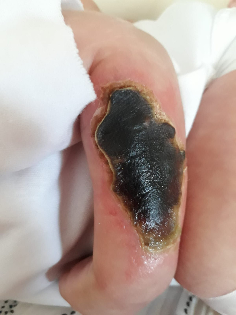 Bursa'da İsa bebeğin kolundaki yaranın sebebi bulunamıyor - Resim: 2