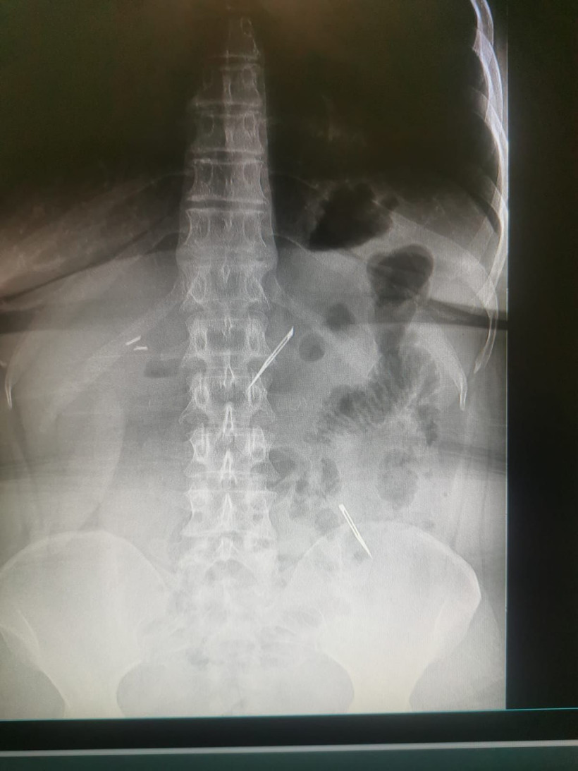 Karın ağrısı şikayetiyle gitti içinden çıkanlar doktoru dehşete düşürdü ekmekle birlikte yutmuş - Resim: 1