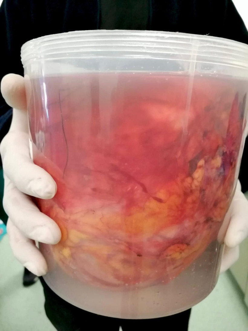 Kanından çıktı! Doktorlar da şoke oldu! Futbol topu büyüklüğünde... - Resim: 3