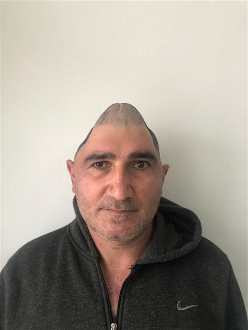 Kafatasının yüzde 83'ü parçalanmıştı! Titanyum parçalarıyla eski görüntüsüne kavuştu - Resim: 4