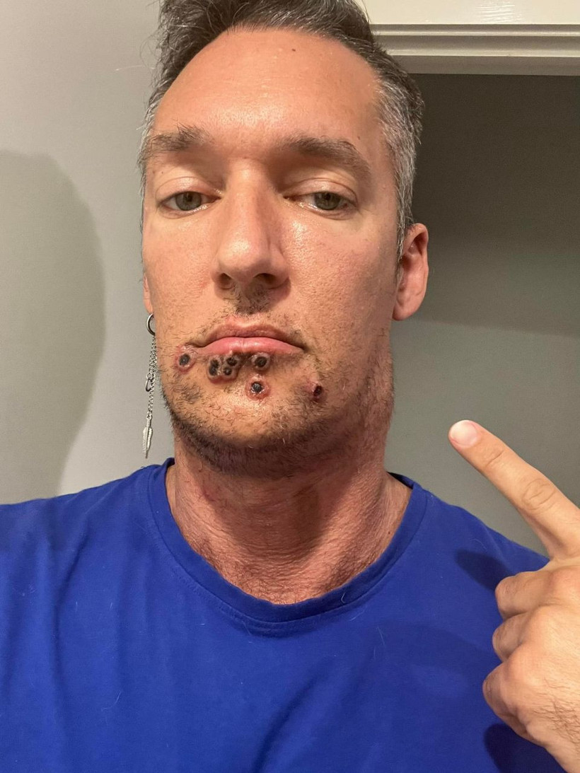 Maymun çiçeği virüsü Türkiye'de! Belirtileri neler? Hastalar anlatıyor: Acıdan çığlık atıyordum - Resim: 4