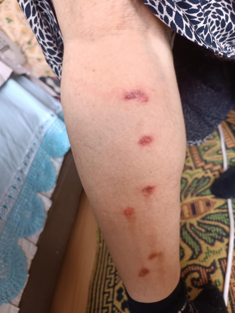 Zeliha'yı lazer epilasyonda yaktılar! Peşin parayla tüylerinden kurtulmak isterken.... - Resim: 2