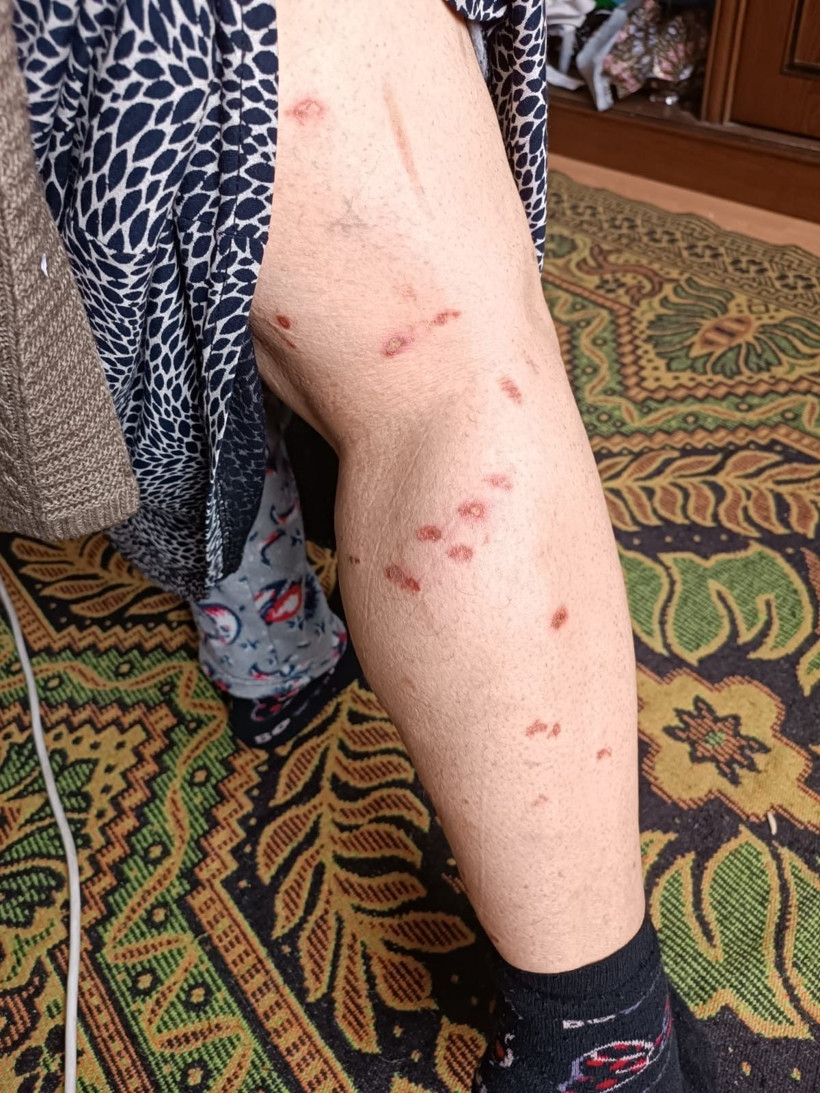 Zeliha'yı lazer epilasyonda yaktılar! Peşin parayla tüylerinden kurtulmak isterken.... - Resim: 4