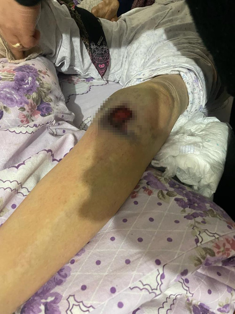 Ankara’da bakıcı dehşeti! 91 yaşındaki kadına resmen işkence yaptılar ölüm kalım savaşı veriyor - Resim: 4