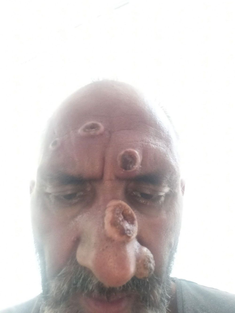 Isıran sinek hayatını kararttı! Tanınmayacak hale geldi tedavi sonrası da... - Resim: 2