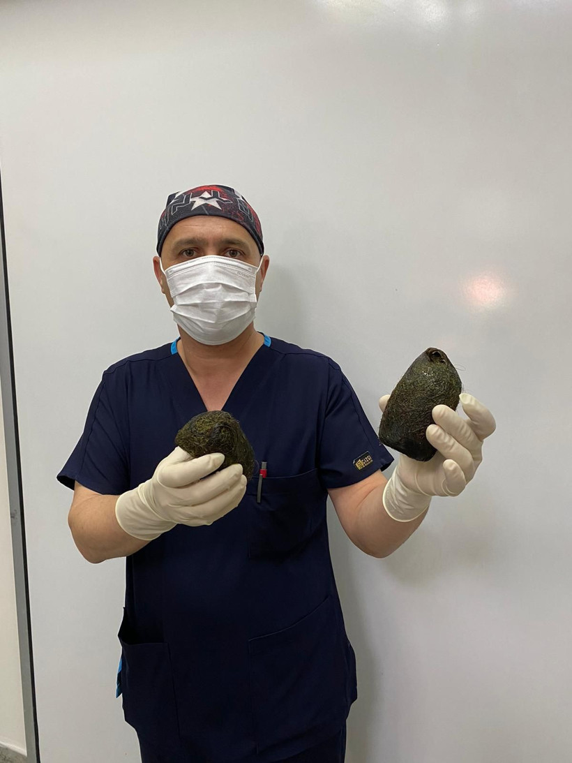 Osmaniye'de bir kadının midesinden 2 kilo saç çıktı - Resim: 1