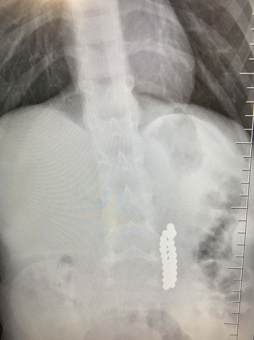 Karın ağrısıyla hastaneye götürdüler çocuğun midesinden çıkanlar hayret verici! - Resim: 3