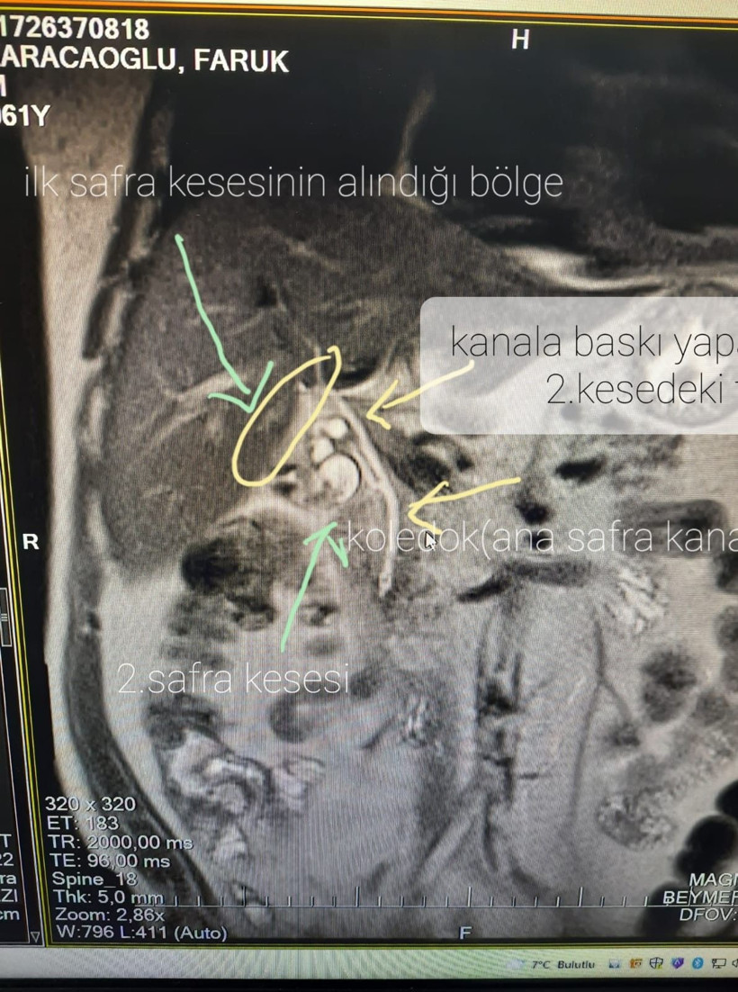Denizli'de 13 yıl sonra ikinci bir safra kesesi olduğunu öğrendi! Kendi de şoke oldu - Resim: 2