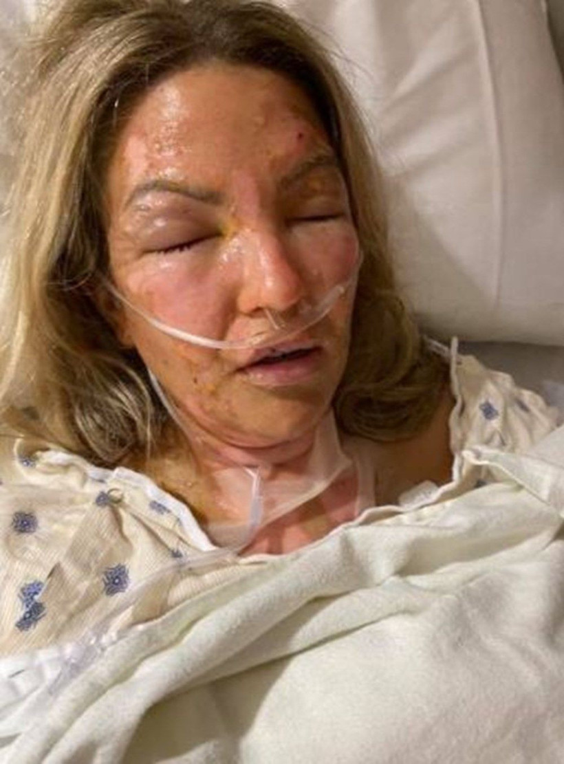 Aman dikkat! Dezenfektan kullandıktan sonra mum yakan kadının vücudu alev aldı - Resim: 4