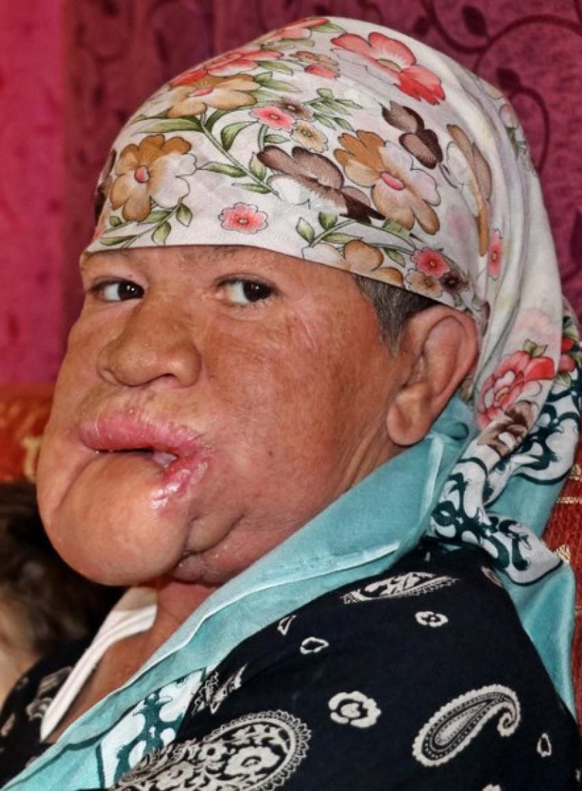 Antalya'da çenesinde çıkan sivilce hayatını kararttı! Meğer bakın neymiş - Resim: 3