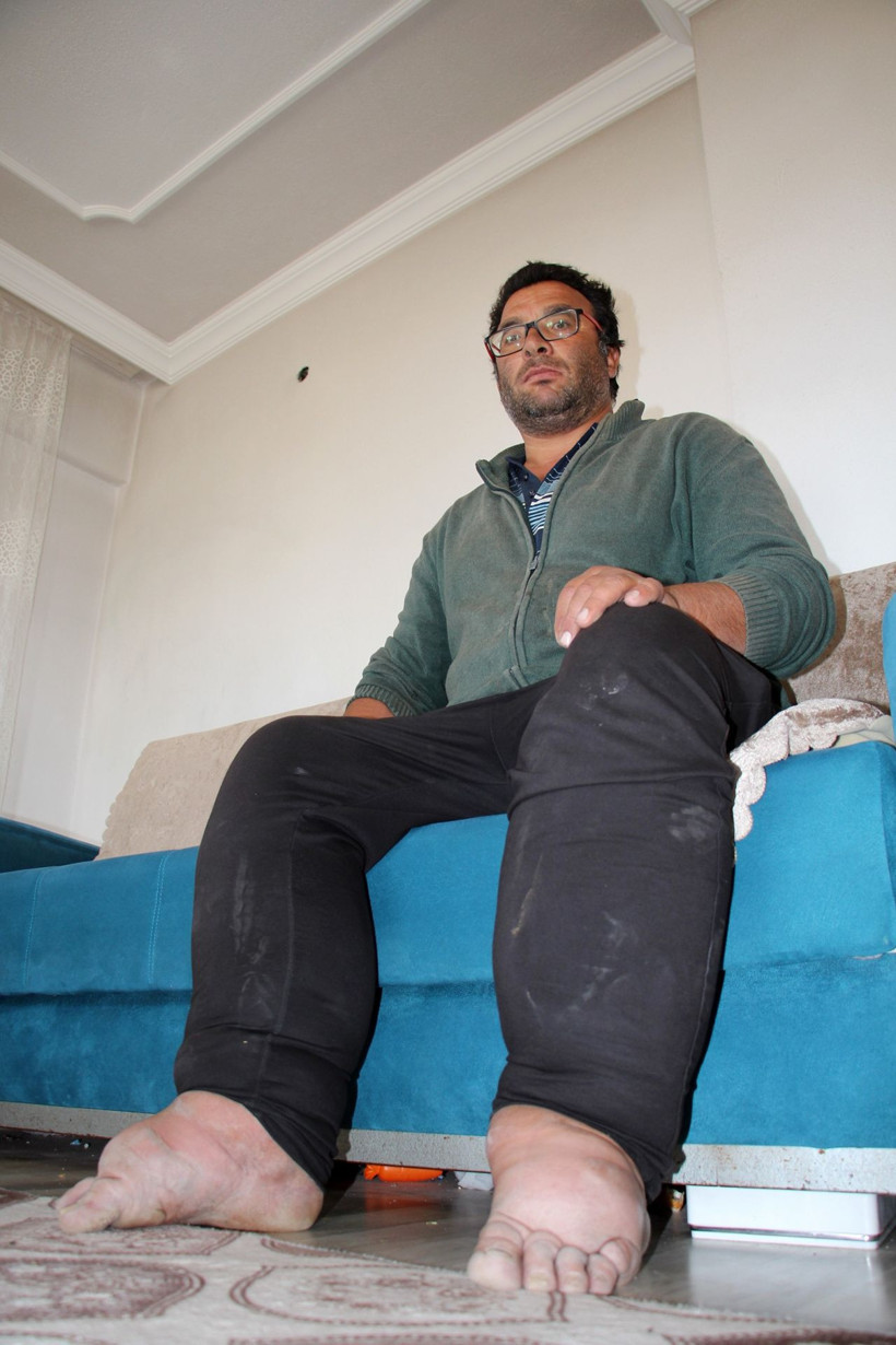 Çok farklı bir hastalığı var ayakları sürekli büyüyor! Sivas'ta bu adamı görenler şoke oluyor - Resim: 2