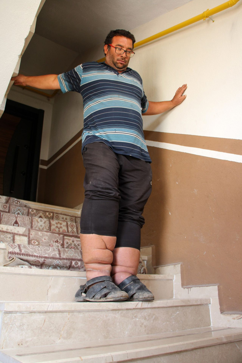 Çok farklı bir hastalığı var ayakları sürekli büyüyor! Sivas'ta bu adamı görenler şoke oluyor - Resim: 1