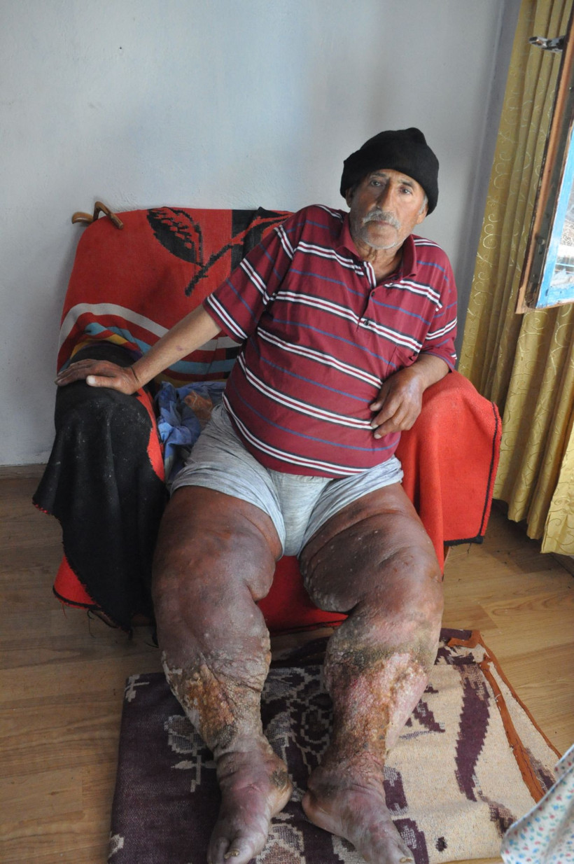 Çürüyen bacaklarını kurtlar yiyor ağır koku yüzünden eve kimse giremiyor - Resim: 1