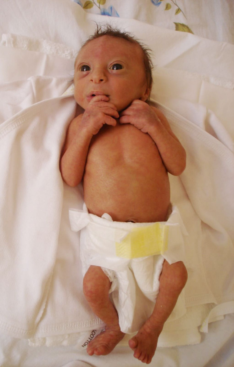 Antalya'da 9 yılda 50 santimetre uzadı! Hastalığından bir tane daha yok - Resim: 2