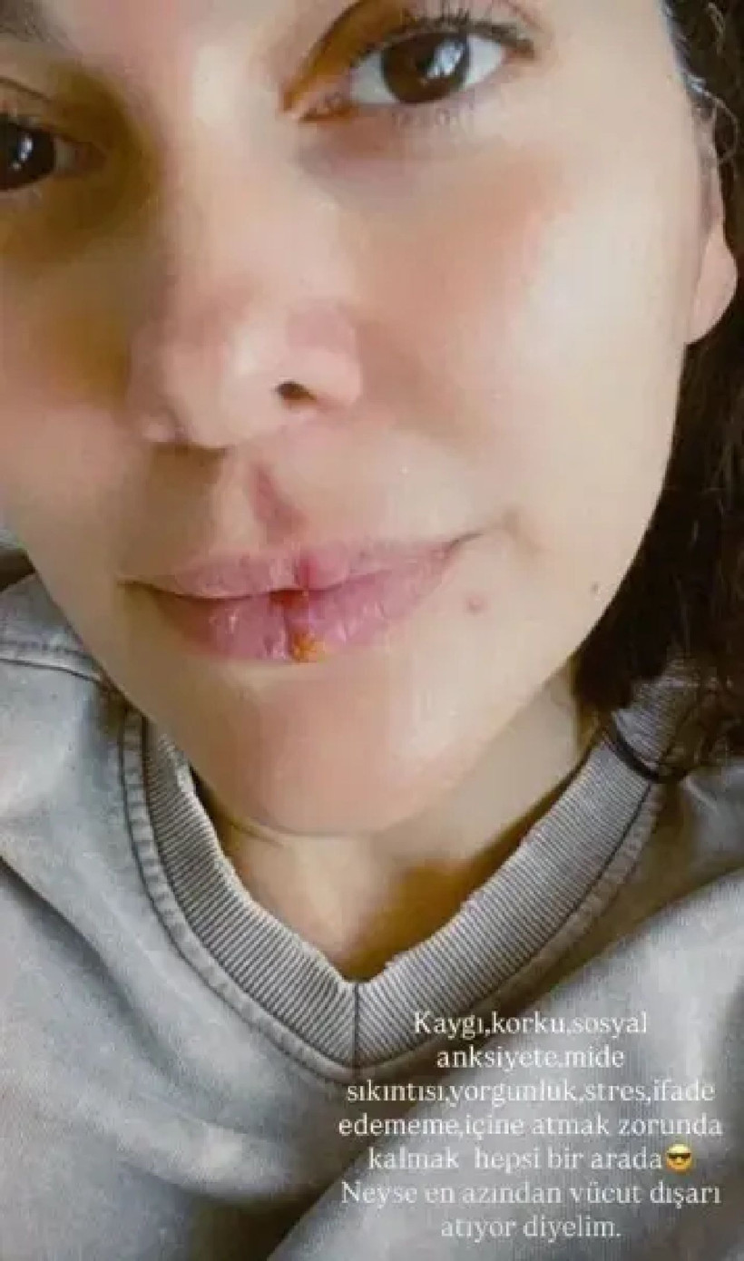 Bergüzar Korel'den şok eden sözler: "Kaygı ve stres bedenime yansıdı" - Resim: 2