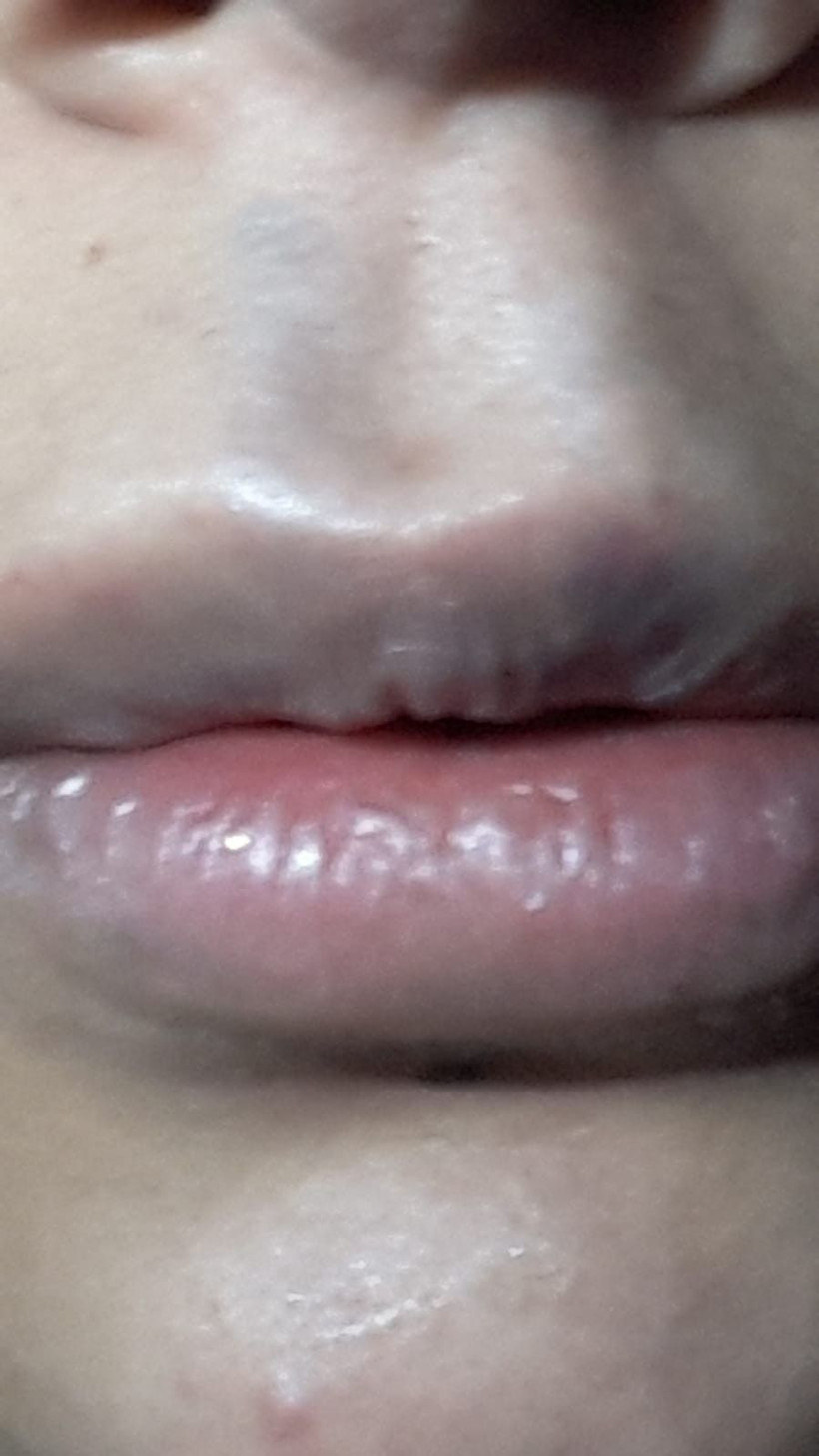 Merdivenaltı rezalet! Koronalı botoks partisinde dudağından oluyordu - Resim: 2