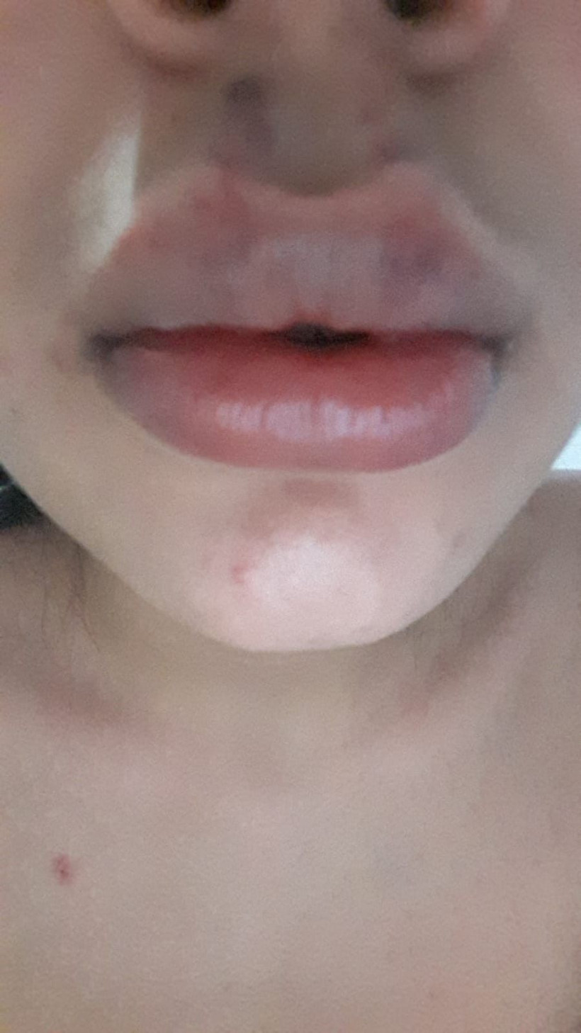 Merdivenaltı rezalet! Koronalı botoks partisinde dudağından oluyordu - Resim: 3