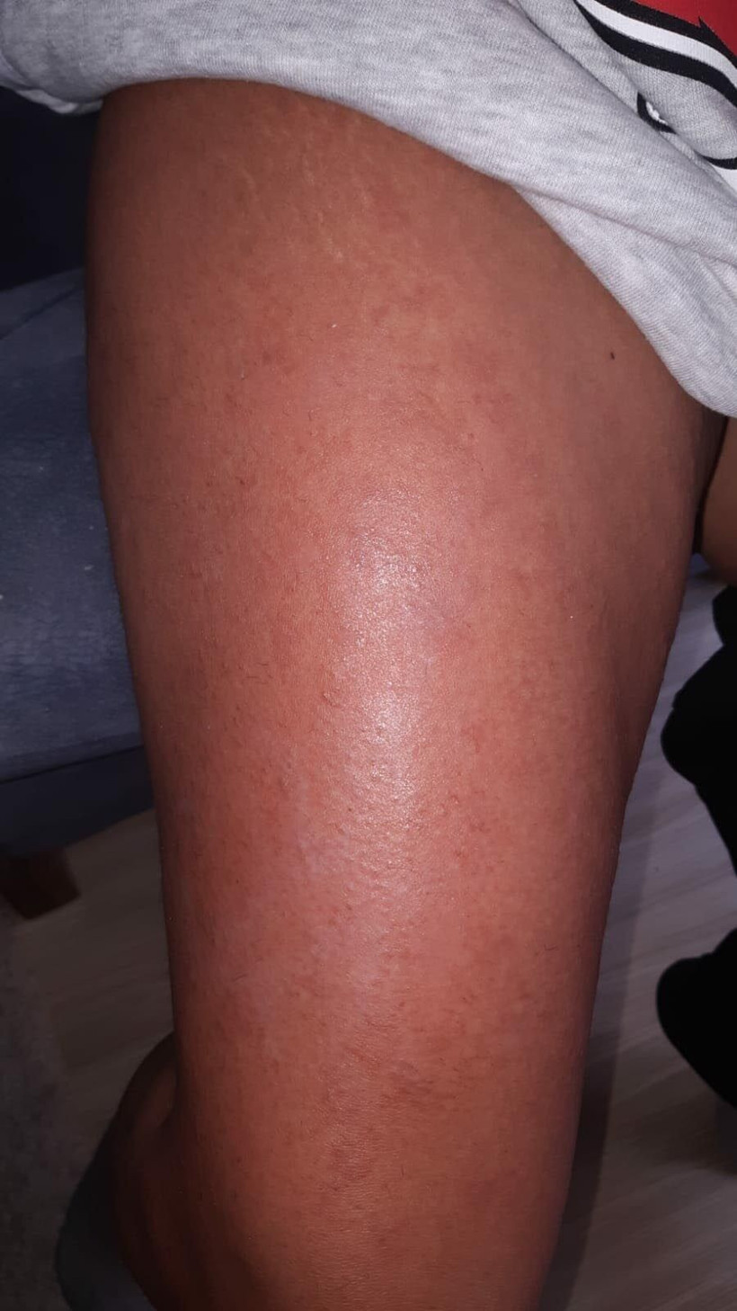 İzmir'de lazer epilasyonda bacaklarını yaktılar güzellik merkezini korku sardı! - Resim: 3