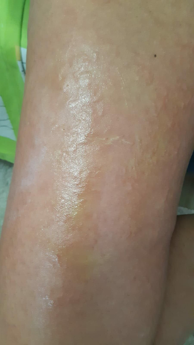 İzmir'de lazer epilasyonda bacaklarını yaktılar güzellik merkezini korku sardı! - Resim: 2