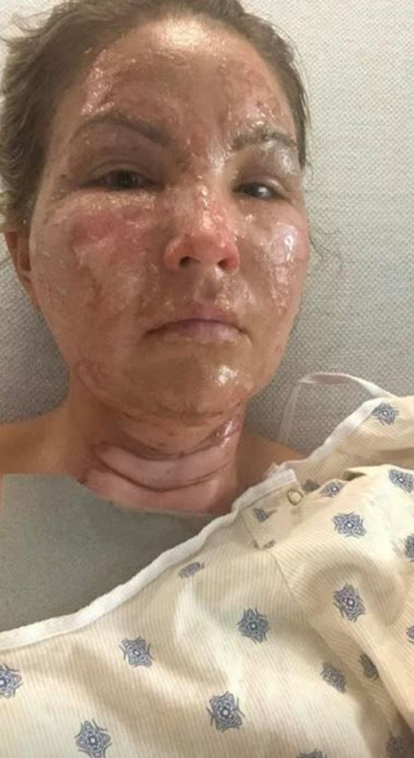 Aman dikkat! Dezenfektan kullandıktan sonra mum yakan kadının vücudu alev aldı - Resim: 2