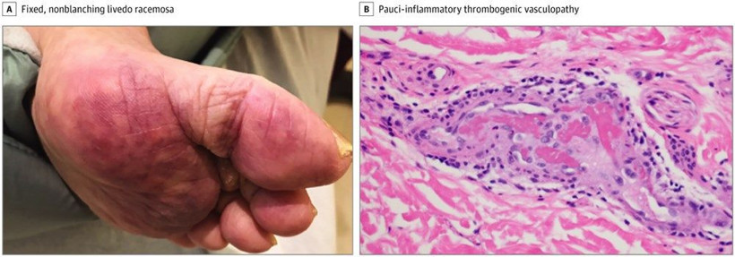 Koronavirüsün cildinizde neden olabileceği semptomlar - Resim: 1