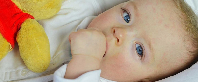 Uzmanı açıkladı! İşte yenidoğan bebeklerde en sık görülen cilt hastalıkları - Resim: 3