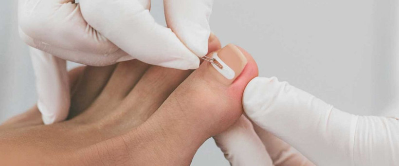 Tırnak batmasına ne iyi gelir tırnak batması tedavisi - Resim: 4