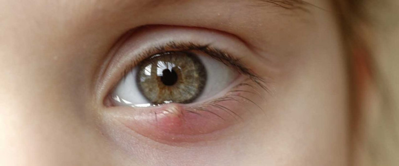 Gözdeki arpacık evde nasıl tedavi edilir? - Resim: 1