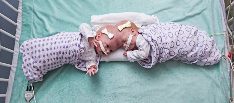 Bu halde doğdular doktorları bile şaşkına çevirdiler daha sonra da ... - Resim: 3