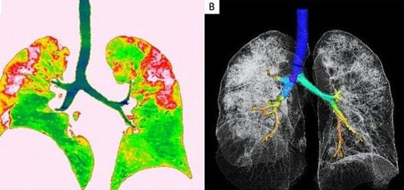 Koronavirüsünün akciğerlere verdiği zarar böyle görüntülendi - Resim: 4
