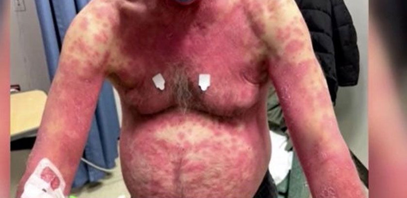 ABD'de Johnson&Johnson aşını vurulan kişide 'yan etki' kabusu! Vücudu döküldü - Resim: 4