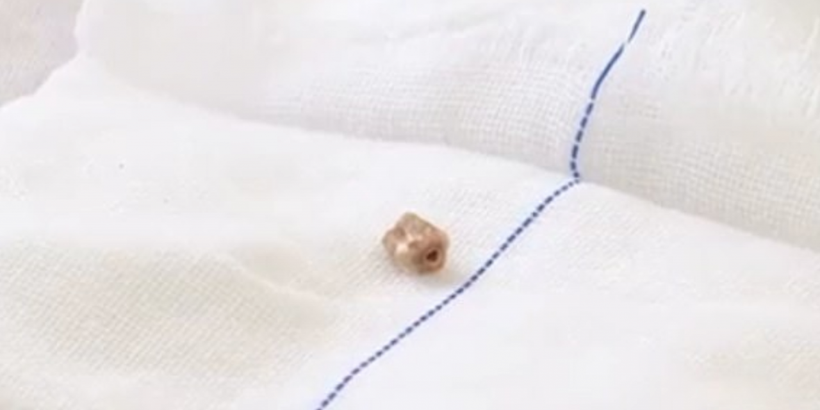 Solunum güçlüğü çektiği gerekçesiyle hastaneye gitti! Burnundan çıkan şoke etti - Resim: 1