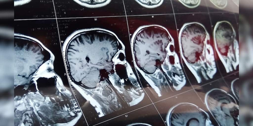 Korona salgını bitmeden yeni salgın başladı! 'Deli dana'ya benzeyen gizemli beyin hastalığı paniği - Resim: 4