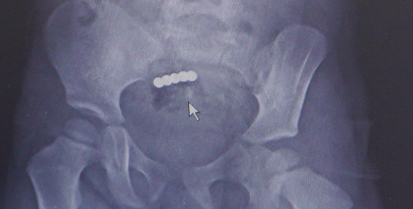 Anne babalar dikkat! Bu oyuncak çocukların hayatını tehdit ediyor 2,5 yaşındaki çocuk ölümden döndü - Resim: 4