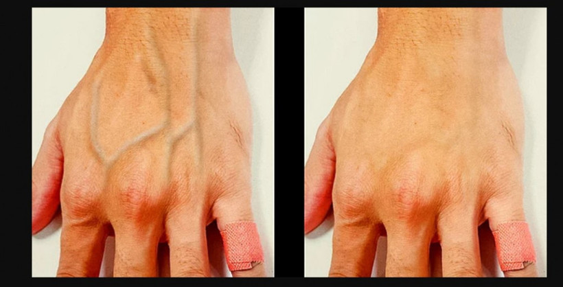 Damarlarınız diğer insanlara çok belirginse dikkat - Resim: 3