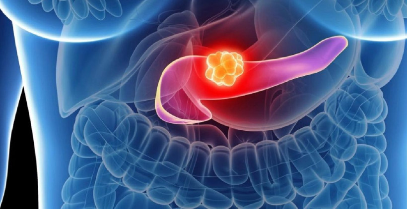 Artık çaresiz değil! Pankreas kanserine "olağanüstü aşı" bulundu! - Resim: 3