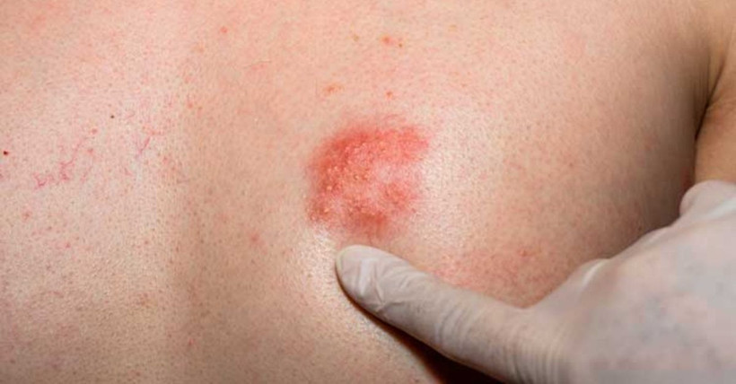 Zona belirtileri neler zonaya ne iyi gelir? - Resim: 1