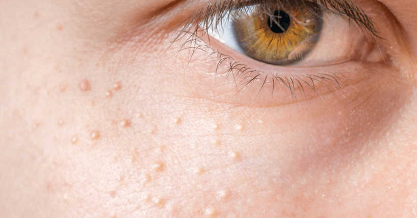 Yüzdeki küçük beyaz noktalar neden oluşur? - Resim: 1