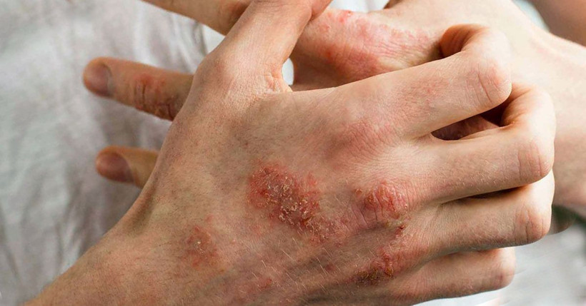 Fazla kolonya kullanımı egzamaya neden oluyor! - Resim: 3