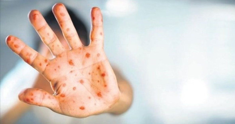 Maymun çiçeği virüsü yayılmaya devam ediyor: Bir ülkede daha görüldü - Resim: 2