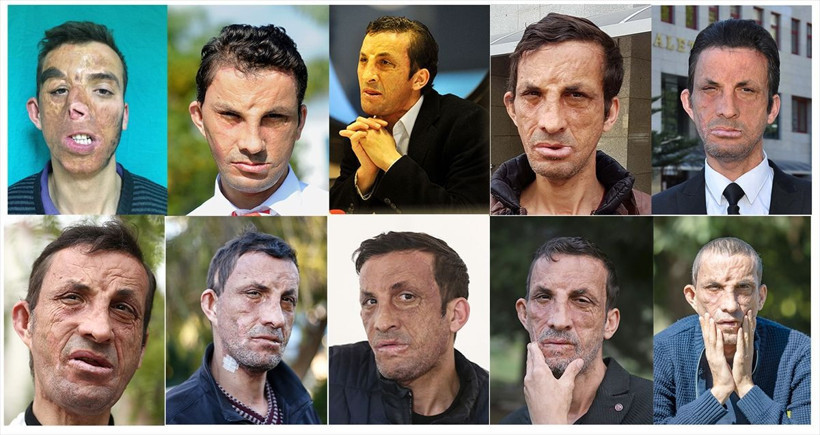 Türkiye'de ilk yüz nakli yapılan isimlerdi! Uğur Acar ve Turan Çolak'ın 10 yıl sonraki haline bakın - Resim: 1